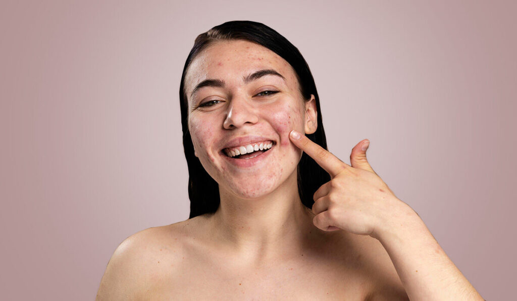 skincare products for acne