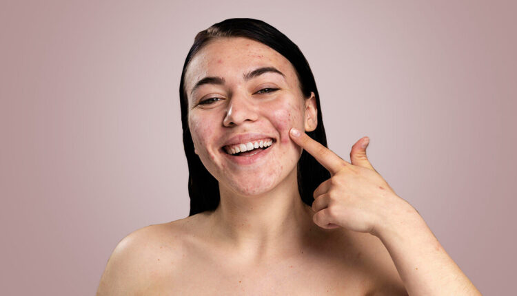 skincare products for acne